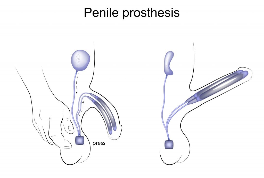 amanda durham recommends Old Man Penile Implant Videos Porn