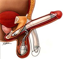 amanda temple recommends old man penile implant videos porn bratu bianca add old man penile implant videos porn photo