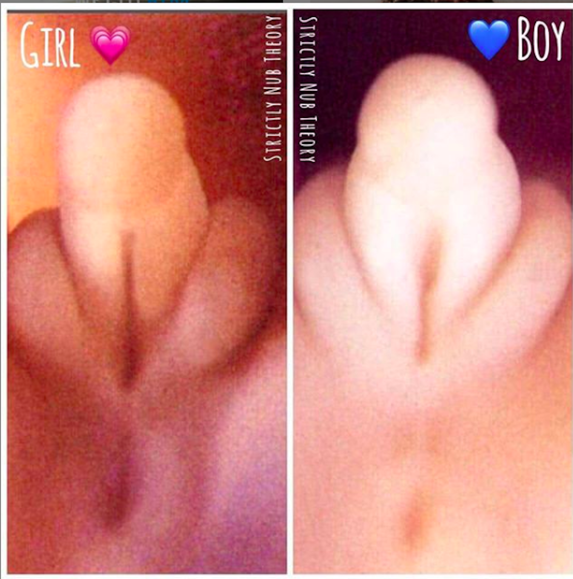 alicia kreiser recommends pictures of women with large clitoris pic
