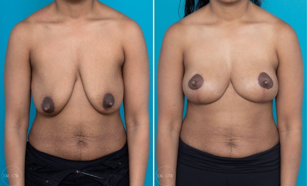 alicia trelles recommends saggy big tits mature carrie broadbent add saggy big tits mature photo