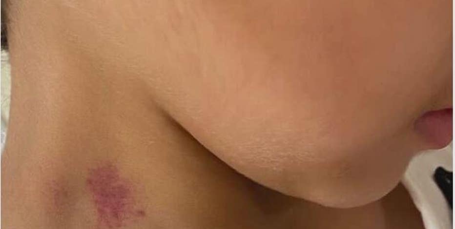 Hickeys On Tits randall pics bill cardin recommends Hickeys On Tits